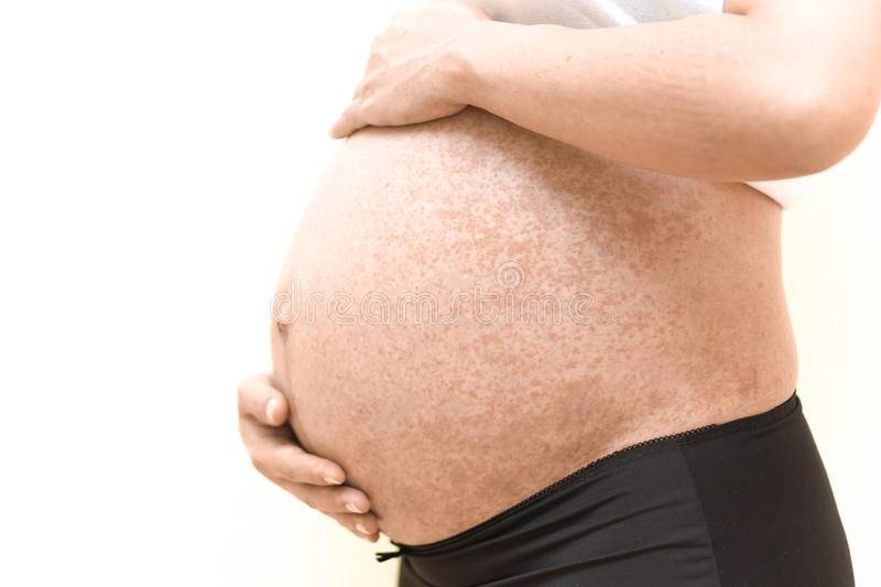 Острые вопросы врачу об аллергии во время беременности