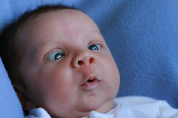 Возможные проявления симптома грефе у новородженных: почему пучит глаза малыш
