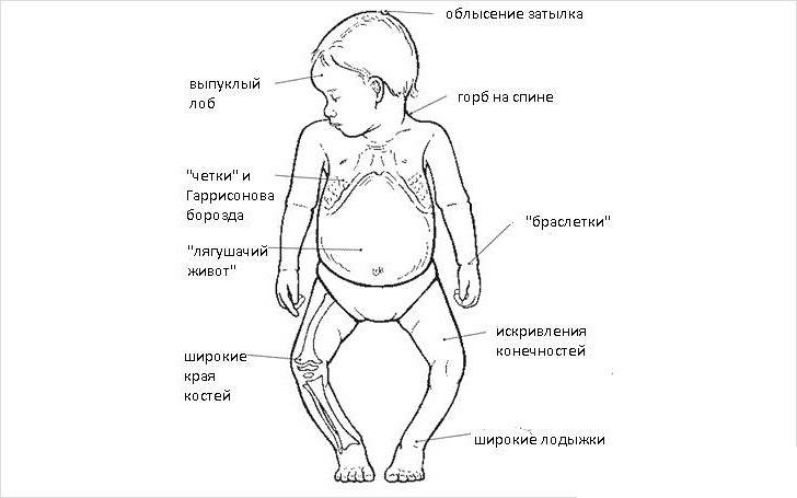 Диагностика и профилактика рахита недоношенных детей