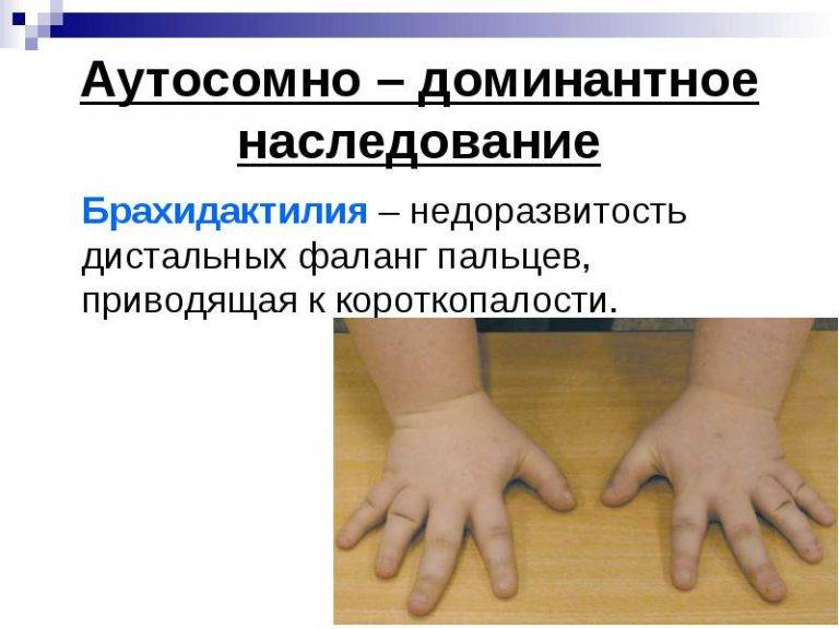 Брахидактилия (короткопалость) — причины, симптомы и лечение аномалии развития рук и ног