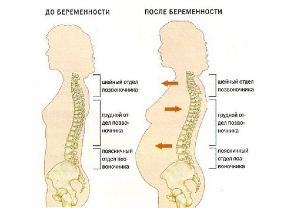 Боли при беременности что делать. Беременность при лордозе поясничного отдела позвоночника. Лордоз поясничного отдела позвоночника после беременности. Изменение позвоночника при беременности. Лордоз беременных.