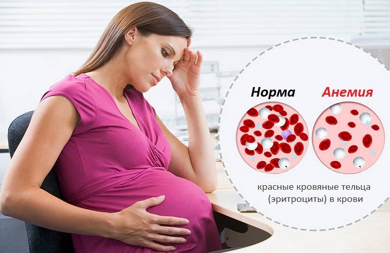 Железодефицитная анемия во время беременности