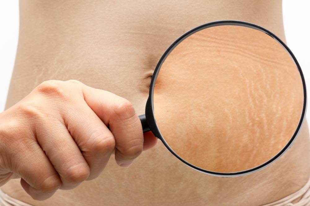 Удаление растяжек, как избавиться и удалить после похудения | доктор борменталь