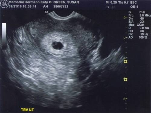 Беременность 5-6 недель. плодное яйцо. этапы развития