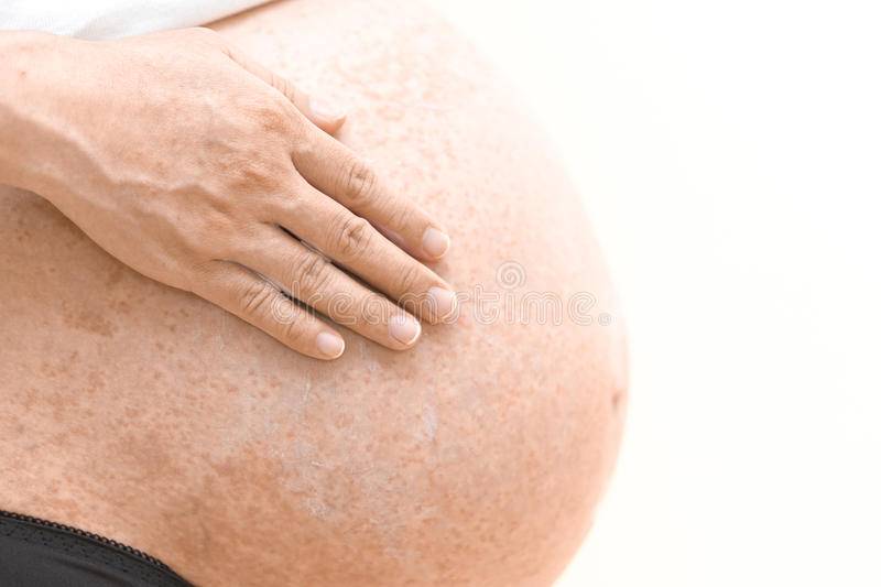 Кожный зуд при беременности