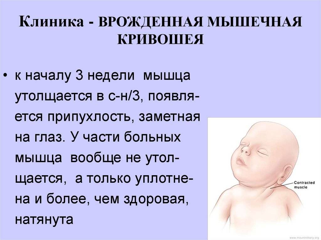 Решаем проблему: кривошея у новорожденного