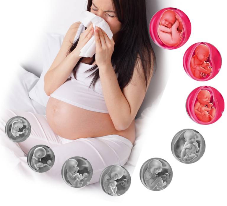 Заложен нос при беременности – что делать и как быстро снять заложенность?