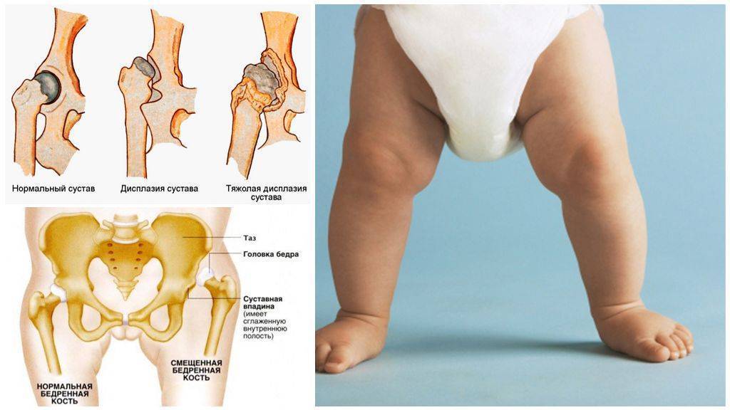 Узи тазобедренных суставов у детей и новорожденных: как делают, что показывает?