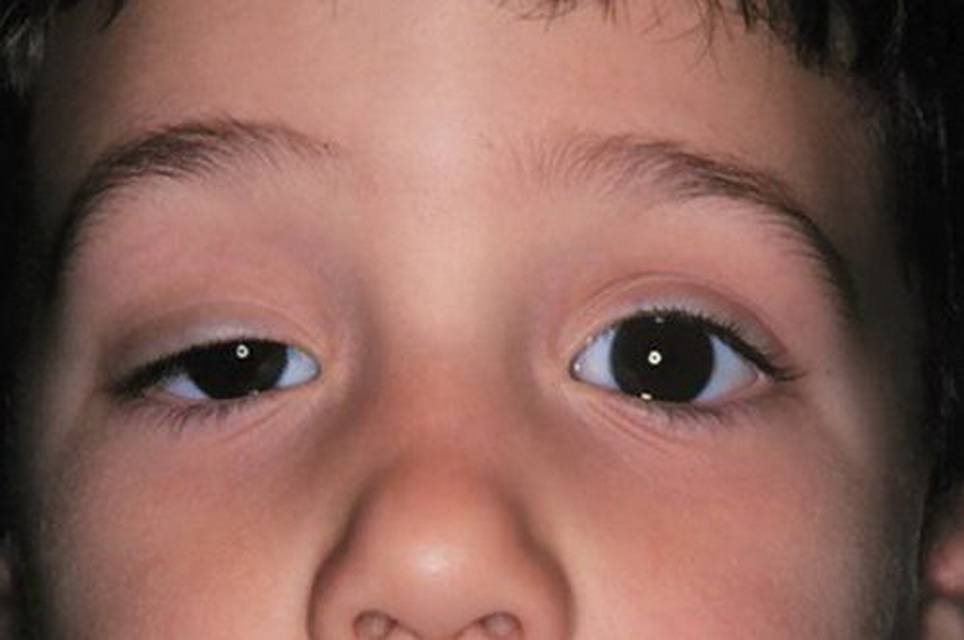 Асимметрия лица у ребенка — когда следует обратиться к врачу