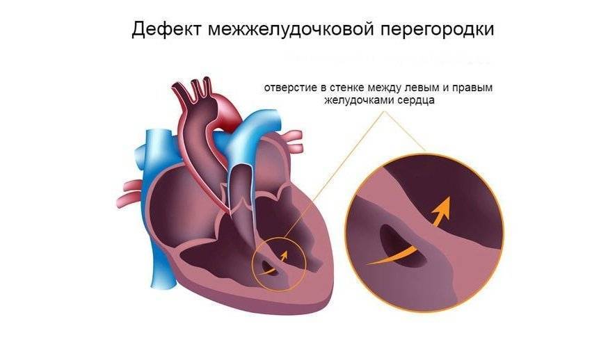 Врожденный порок сердца