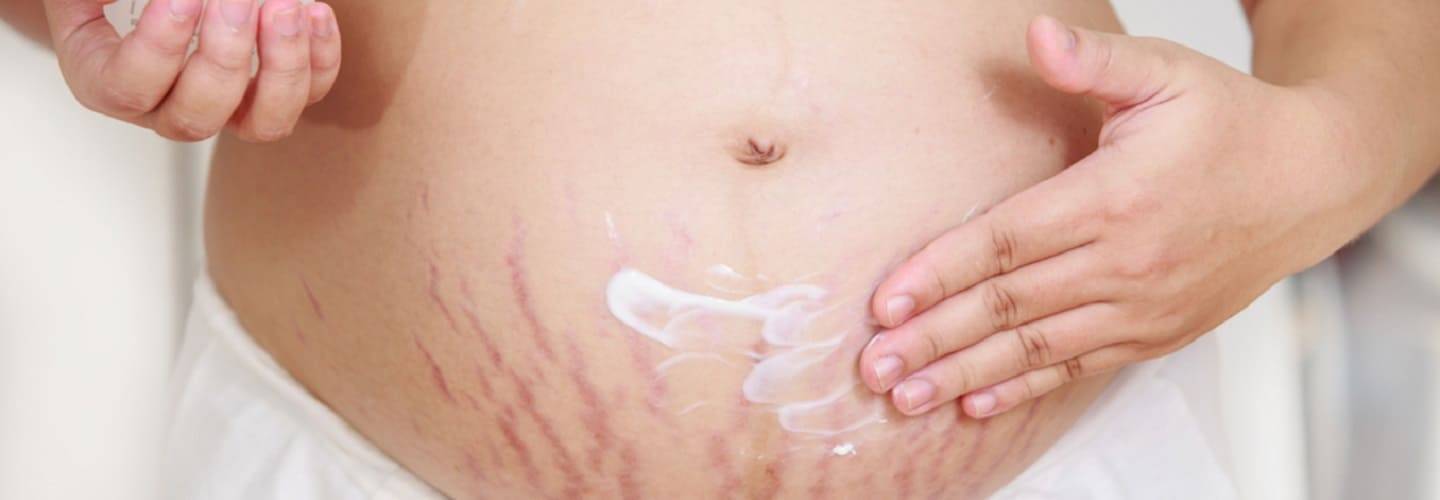 Растяжки при беременности | причины и профилактика растяжек