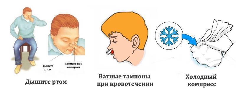 Перелом носа у ребенка: симптомы и признаки