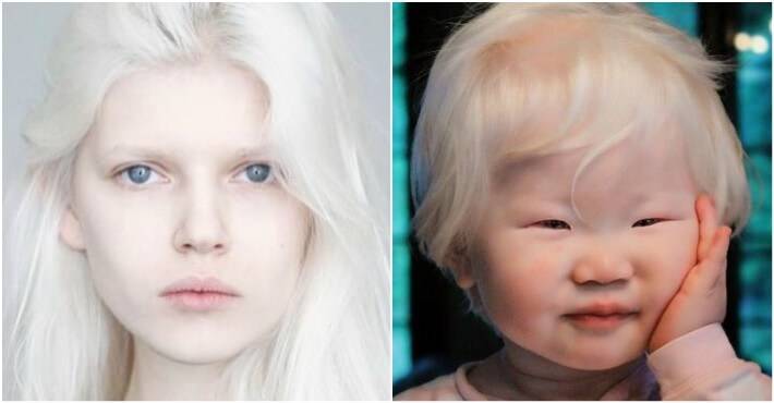 «Белая ворона», или Особенности здоровья и развития ребенка-альбиноса