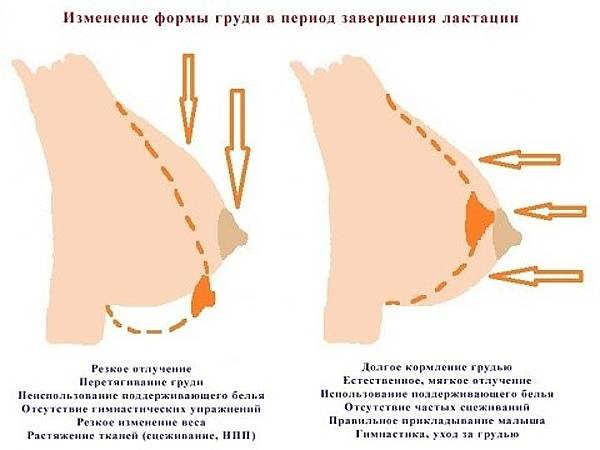 Асимметрия груди при гв: одна грудь больше другой после кормления, что делать если ассиметрия груди