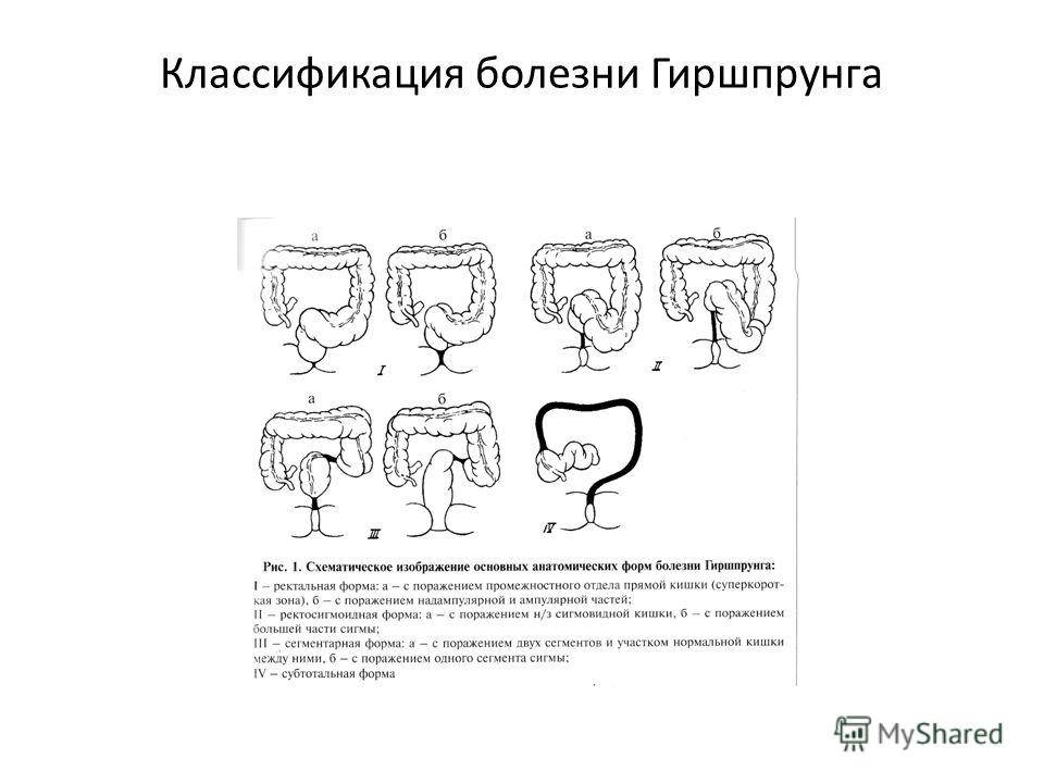Долихосигма | симптомы | диагностика | лечение - docdoc.ru