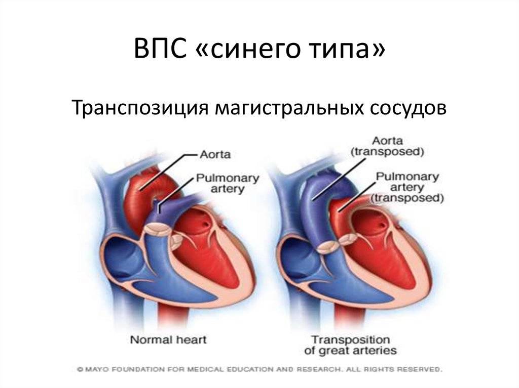 Пороки сердца у детей презентация