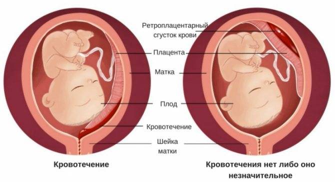 Отслойка плаценты: симптомы, диагностика, лечение - поиск врачей и клиник в москве