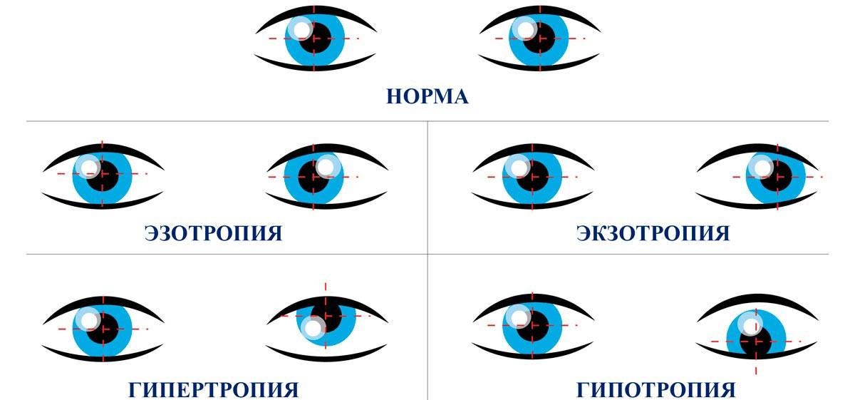 Презентация на тему косоглазие