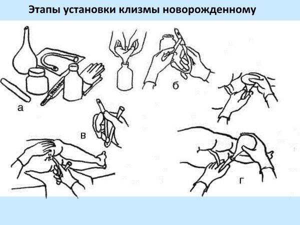 Как пользоваться спринцовкой гинекологической в картинках пошагово