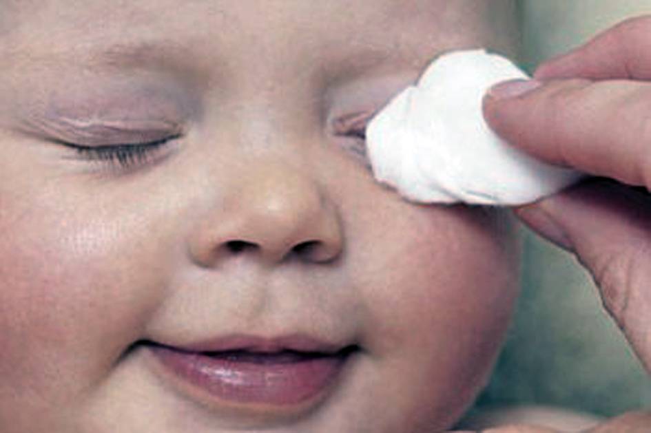 Промывание глаз при конъюнктивите: можно ли использовать физраствор? «ochkov.net»