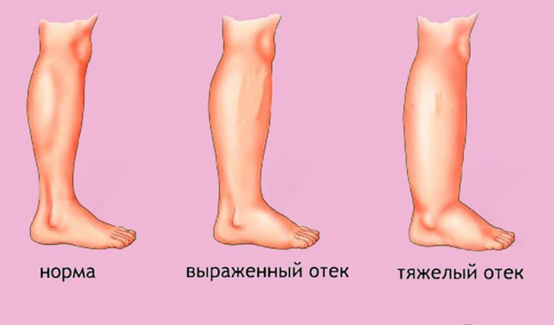 Отёки ног при беременности - «институт вен»  лечение варикоза в  киеве и харькове