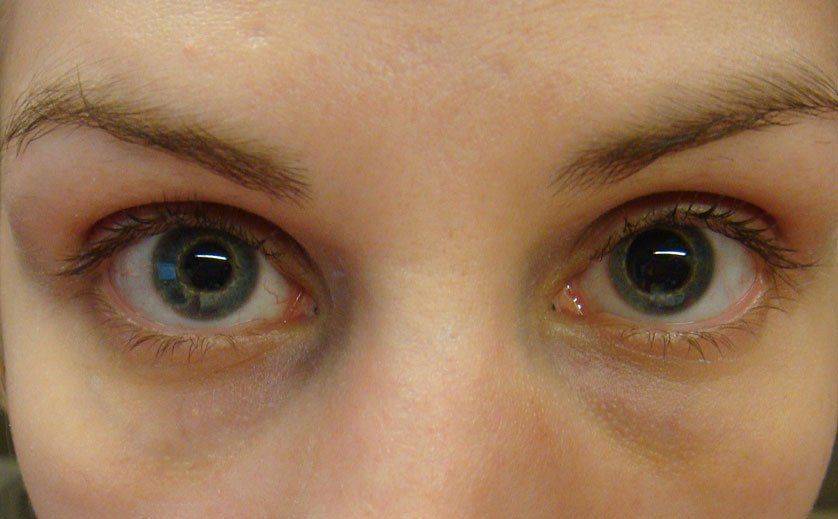 Асимметрия глаз у грудничка лечение комаровский