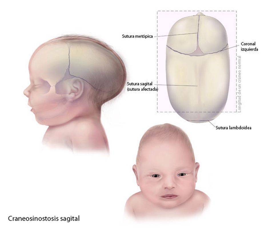 Правильная и неправильная форма черепа новорожденного ребенка, виды деформации головки – что является патологией?