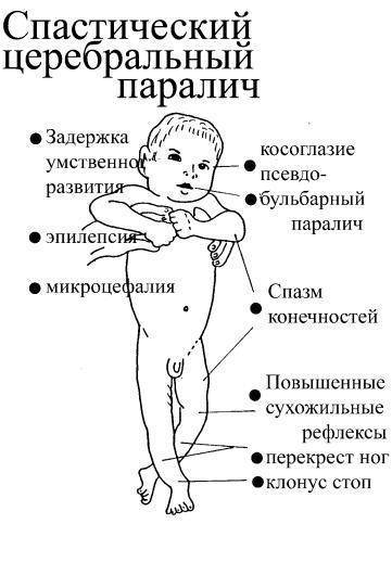Синдром двигательных нарушений у детей (грудничков): развитие, лечение