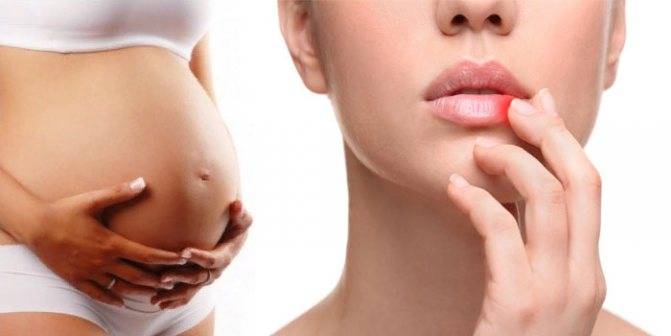 Что делать, если на губах при беременности появился герпес?