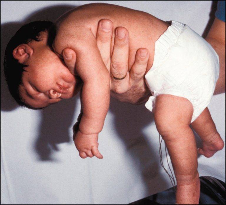 Гипертонус мышц и сон ребенка
