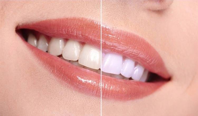Гарантированное восстановление сильно разрушенных зубов.