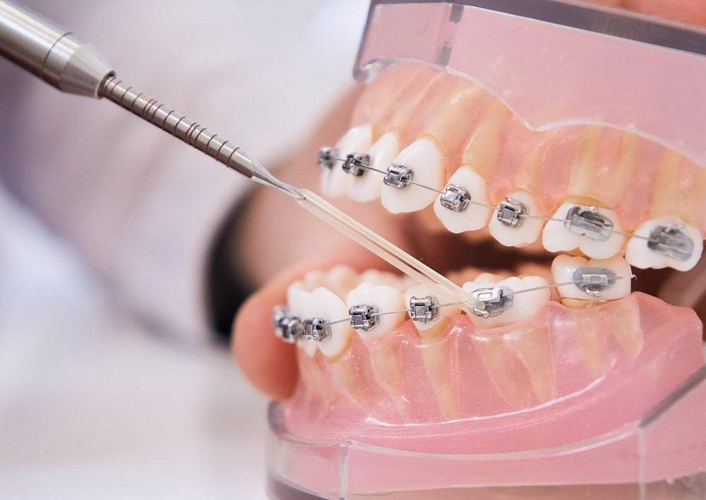 Скобы для зубов