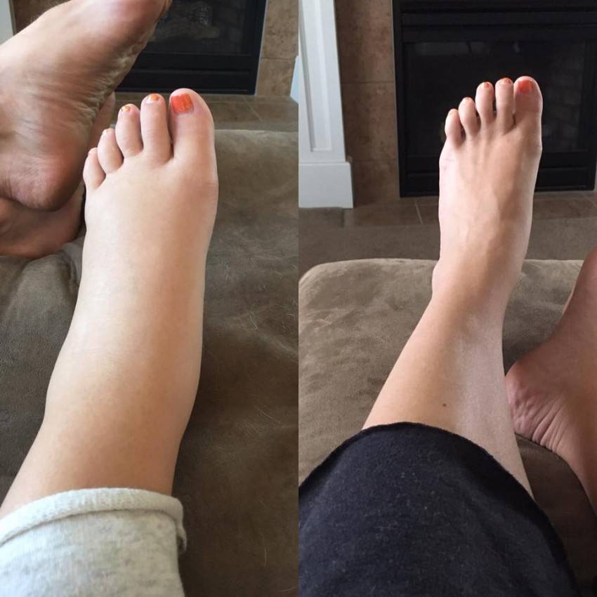 Венозные заболевания – отеки лодыжек и ног поддаются лечению