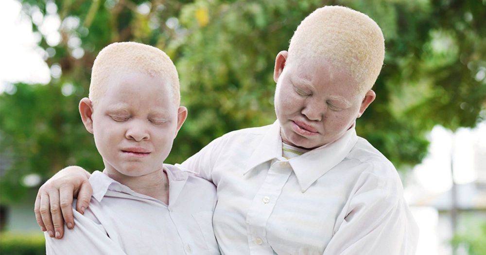 «Белая ворона», или Особенности здоровья и развития ребенка-альбиноса