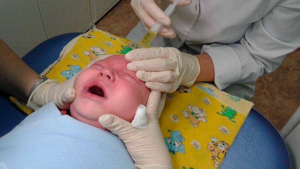 Лечение дакриоцистита новорожденных - операция или массаж при дакриоцистите в москве: свао, метро отрадное, бибирево, владыкино