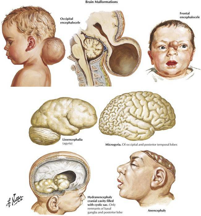 Сотрясение головного мозга у грудничка: симптомы и признаки у детей до года - как распознать и определить, как проявляется, диагностика и последствия