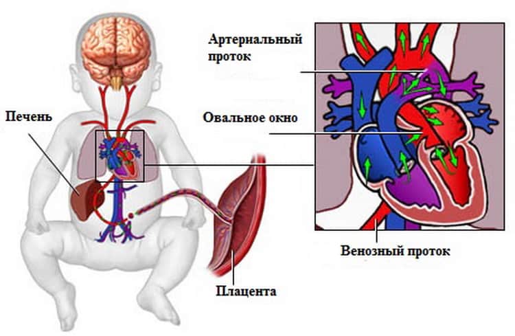 Коарктация аорты - лечение эндоваскулярными методами в отделении института амосова.