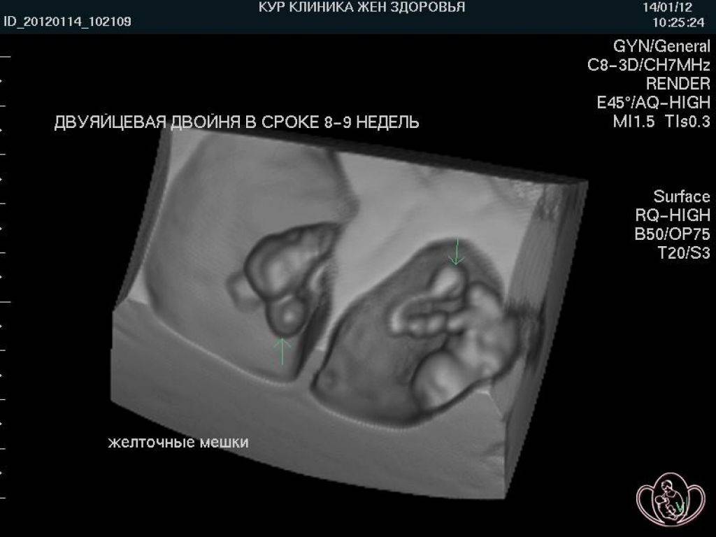 Двойня 8 недель беременности фото узи