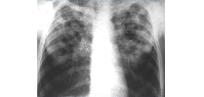 ✅ признаки туберкулеза у детей: 4 ранних симптома, на которые важно обратить внимание - ik-rt.ru