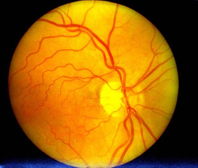 Какие глазные заболевания передаются по наследству? «ochkov.net»