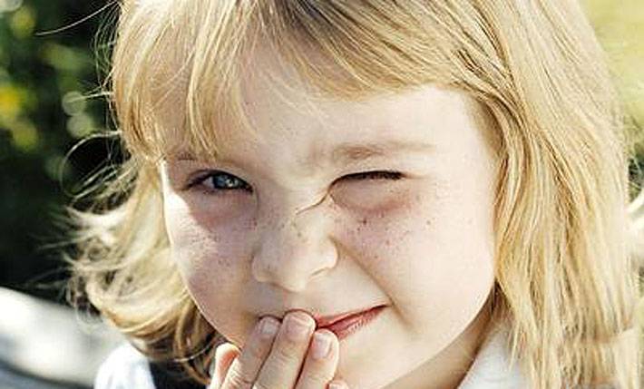 Нервный тик у ребенка моргание глазами | нейроспектр