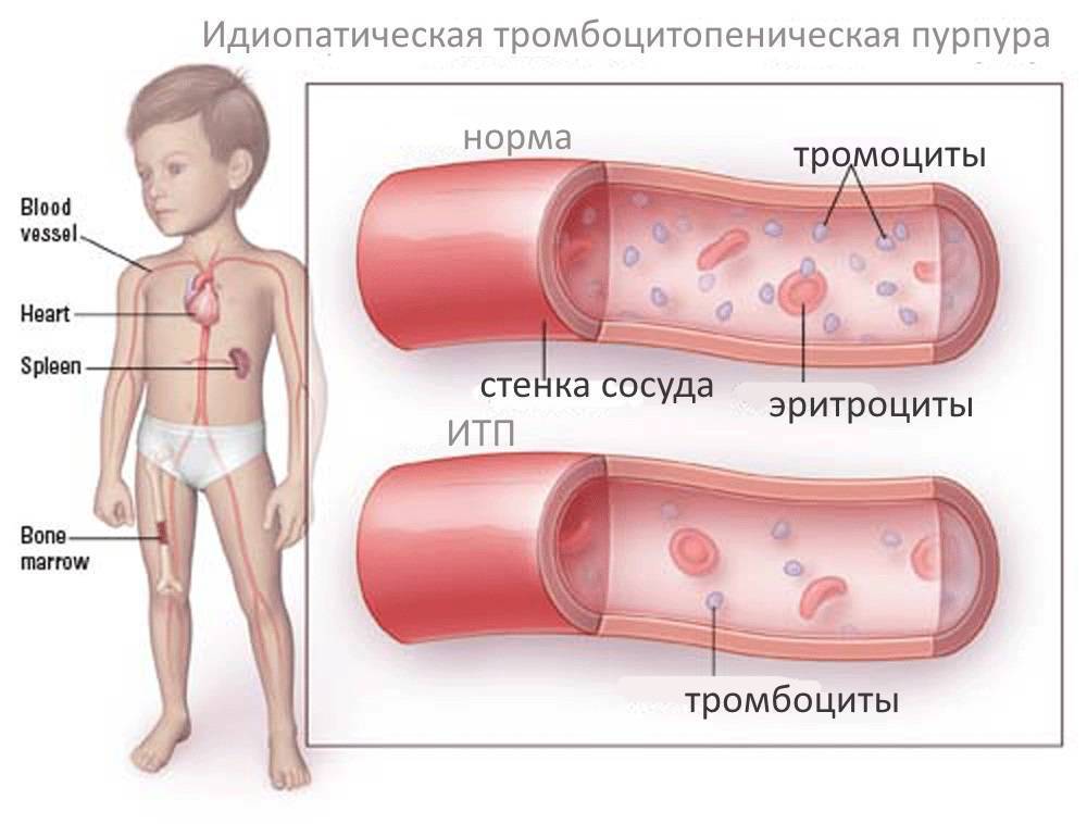 Тромбоцитопения (пурпура)