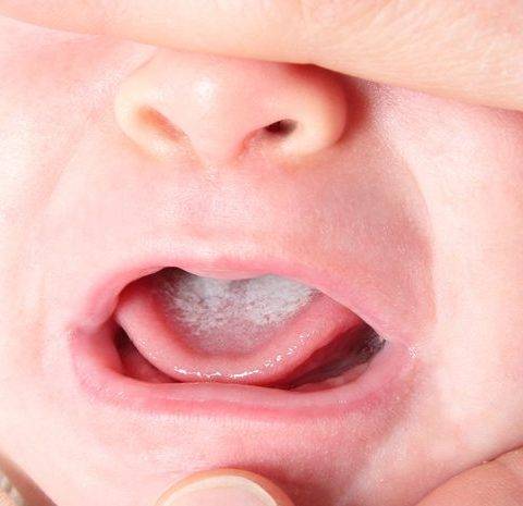 Белый налет на языке у грудничка - причины и лечение