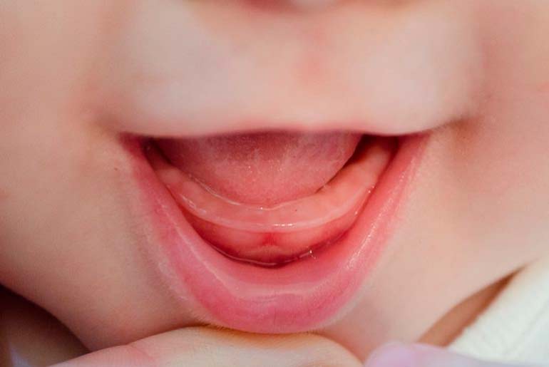 Как режутся зубы у грудничков: признаки и симптомы, как определить