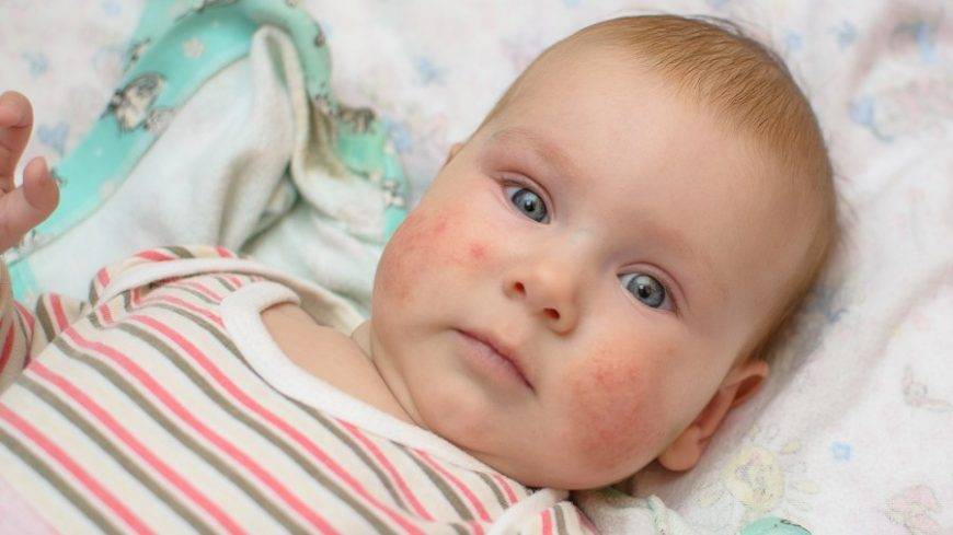 Аллергия у детей — виды, симптомы, что делать, чем лечить