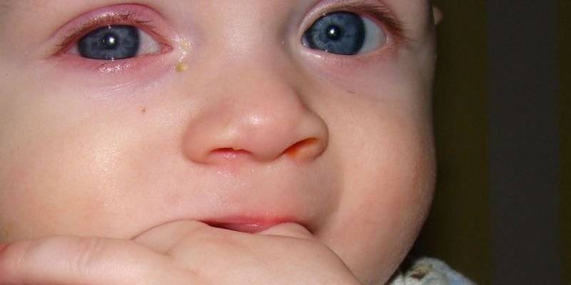 Конъюнктивит у малыша до года — чем лечить? - энциклопедия ochkov.net