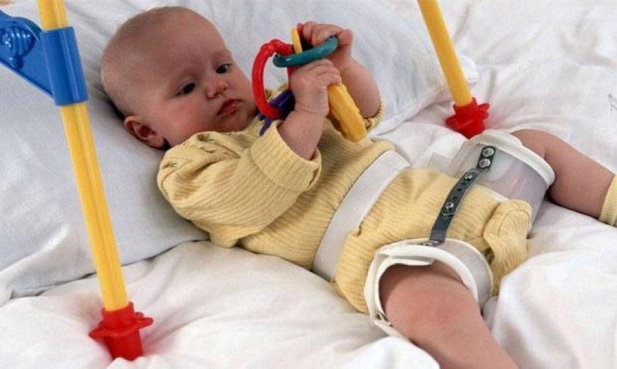 Дисплазия тазобедренных суставов у ребенка - лечение