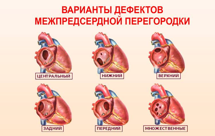 Дырочки в сердце у новорожденного - здоров.сердцем