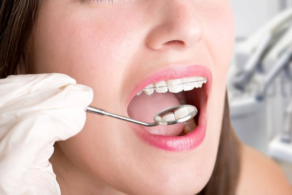 Как убрать щель между зубами: 7 методов лечения