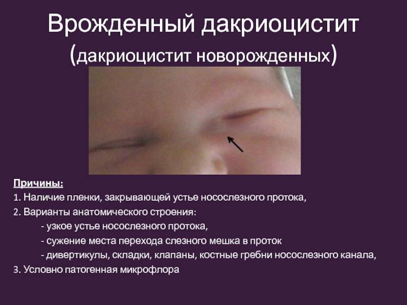 Осложненная катаракта - что это такое? лечение осложненной катаракты в клинике fedorovmedcenter.ru